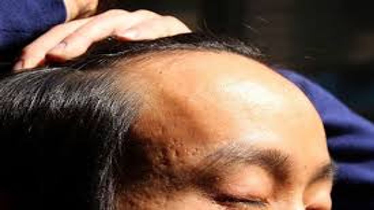 Hair loss treatment in South Korea became a new election issue